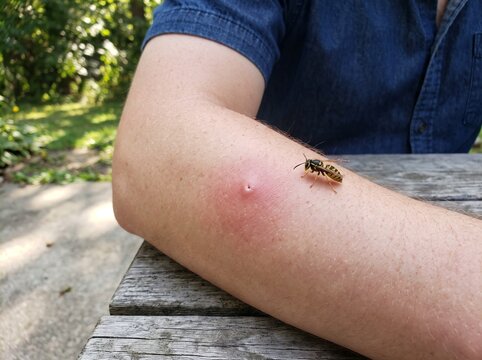 Wasp Sting Pictures Showing Skin Reactions, Swelling, Redness, Insect Bite Symptoms, First Aid, and Healthcare Awareness Information