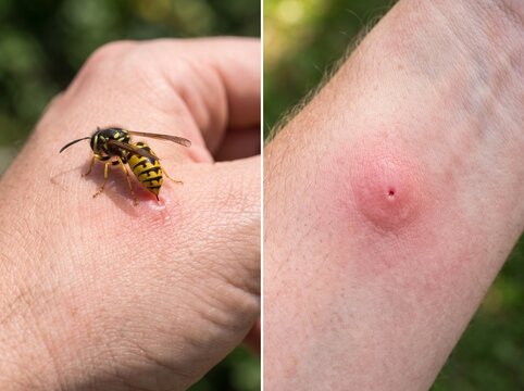 Wasp Sting Pictures Showing Skin Reactions, Swelling, Redness, Insect Bite Symptoms, First Aid, and Healthcare Awareness Information
