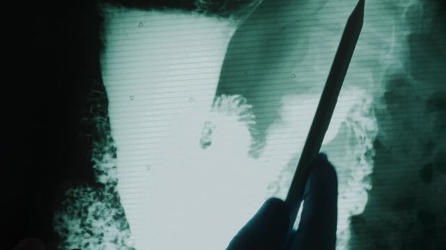 Medical doctor pointing at a fluoroscopy x ray of a stomach during a barium swallow examination