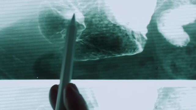 Doctor pointing with a pencil at a fluoroscopy image of a barium enema examination
