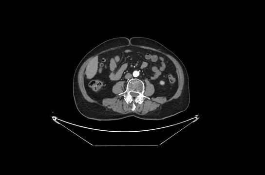 Contrast-Enhanced CT Abdomen and Pelvis Arterial Phase Axial 1.25 mm DICOM Medical Imaging Anatomy Loop