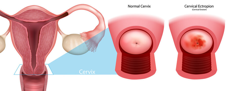 Normal Cervix and Cervical Ectropion Anatomical Diagram of the Female Reproductive System. Cervical Erosion Anatomy Medical Illustration