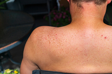 Fototapeta premium freckled skin showing natural texture and pigmentation after summer sunshine. Dermatology, skincare, beauty, skin health and cosmetic research concept
