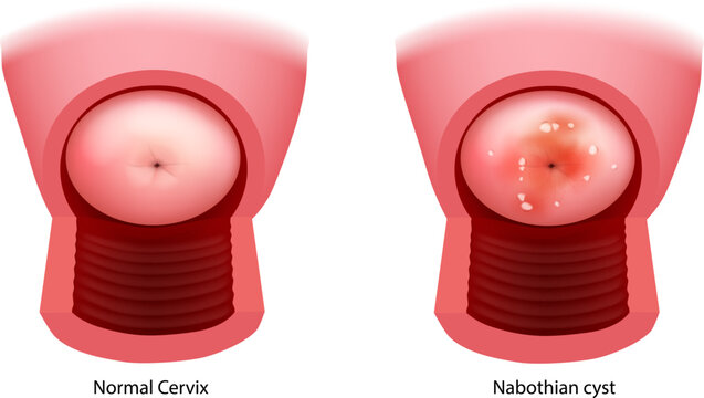 Normal Cervix and Nabothian Cyst Comparison Medical Illustration of Benign Cervical Mucous Retention Cysts. Benign Cervical Gland Obstruction