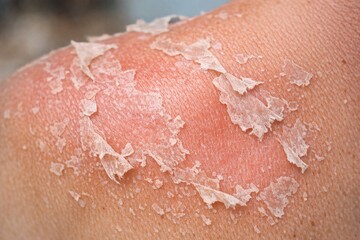 Fototapeta premium A close-up shot of human skin showing vitiligo, a condition characterized by white patches