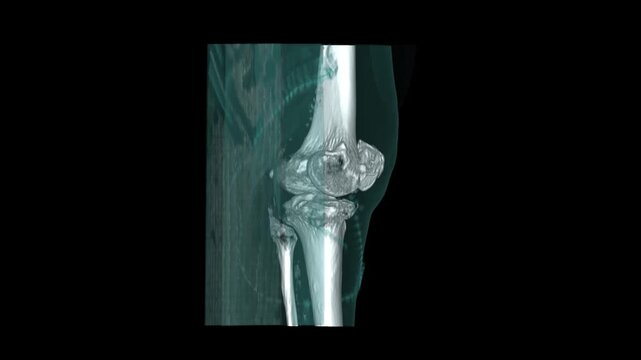 3D volume rendered CT scan reconstruction of a left knee joint showing femur patella tibia and fibula bones