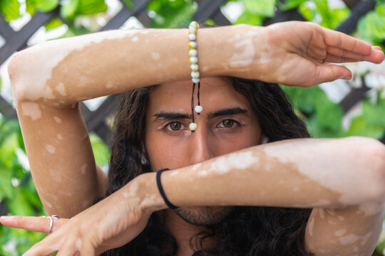 Portrait of Middle Eastern man with vitiligo outdoors