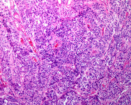 Urinary bladder. Transitional cell carcinoma