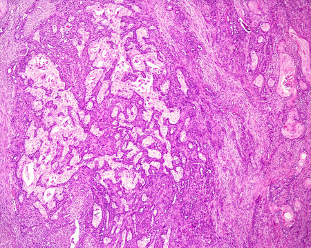 Skin. Squamous cell carcinoma