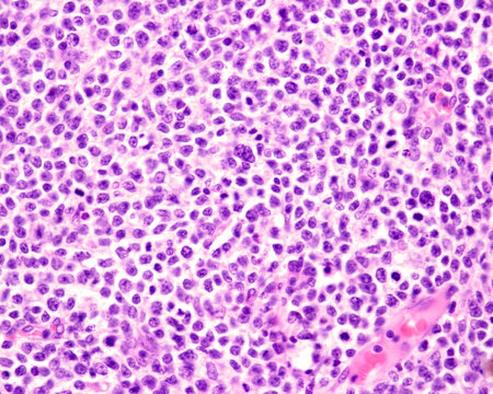 Human lymph node. Hodgkin lymphoma