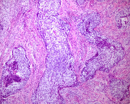 Human cervix. Squamous cell carcinoma