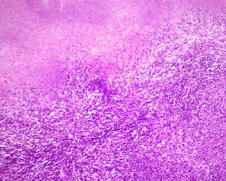 Human lymph node. Caseous tuberculous lymphadenitis