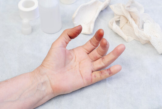 Contractures of the ring and little fingers are visible on the hand, Skin discoloration and minor bruising are also observed,and rests on blue medical sheet with sterile gauze and vials of solution