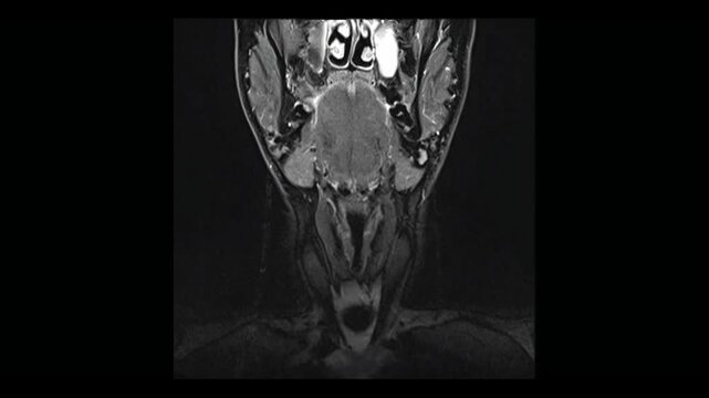 Coronal MRI scan of human neck and cervical spine area. Professional medical imaging diagnostic video sequence tracking muscle and vertebrae tissue