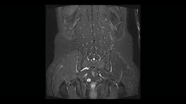  Coronal abdominal MRI scan visualization highlighting kidneys and urinary bladder. Medical animation sequence for internal organs diagnostic and research.