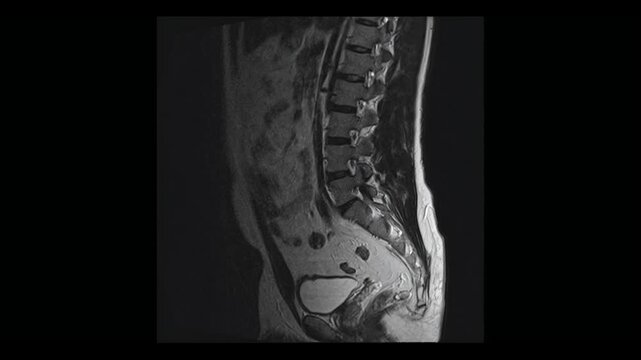  Lumbar spine MRI scan in sagittal projection showing lower back vertebrae and sacrum. Medical diagnostic footage for back pain and spinal health concept.
