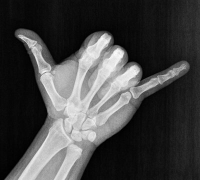 Film xray x-ray or radiograph of hand and fingers showing skelton bones doing shaka sometimes known as hang loose is a gesture with friendly intent often associated with Hawaii aloha and surf culture