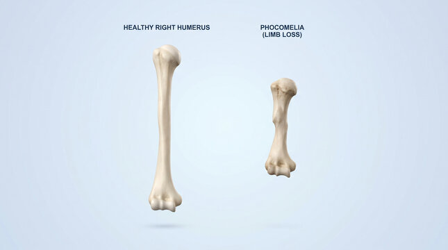 Congenital phocomelia limb reduction defect and healthy humerus bone comparison

