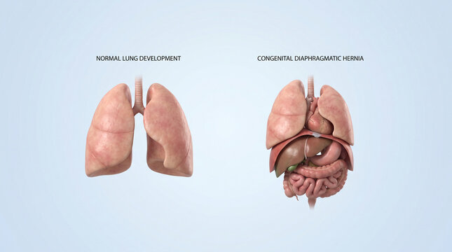 Normal Lungs vs Congenital Diaphragmatic Hernia 3D Anatomy
