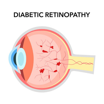 Diabetic retinopathy anatomical poster. Human eye disease, vision loss or blindness. Damaged blood vessels in the retina. Proliferative or nonproliferative eye condition medical vector illustration