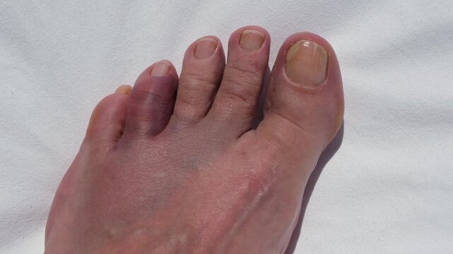 Swollen bruised toe after accidental impact with a rock, concept of foot injury, accident, first aid, healthcare and recovery.