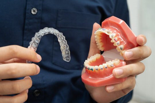 Man holding invisible aligner orthodontic retainer for dental teeth straightening.