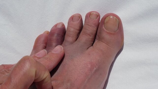 Bruised and swollen toe after hitting a rock, concept of foot injury, pain, trauma, healthcare and recovery.