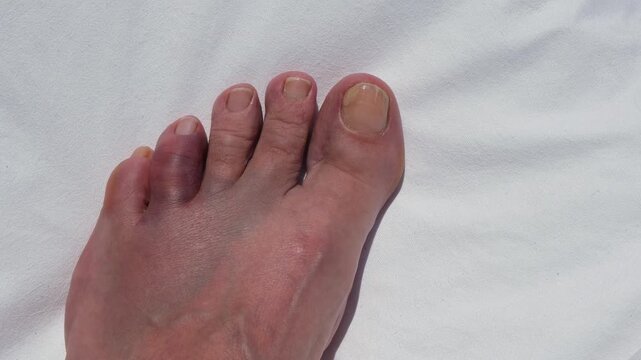 Bruised and swollen toe after hitting a rock, concept of foot injury, pain, trauma, healthcare and recovery.