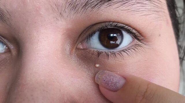 Woman touching milia near the eye, facial skin care, milia removal, dermatology and cosmetic skin treatment concept.