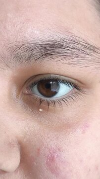 milia on facial skin near eye, skincare routine, dermatology and cosmetic treatment concept.