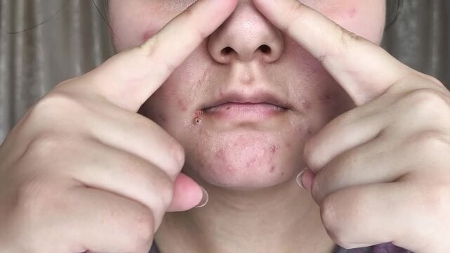 Close up of woman indicating acne-prone area on face, facial skincare, dermatology and healthy skin concept. problematic skin, skincare routine and dermatology awareness concept.