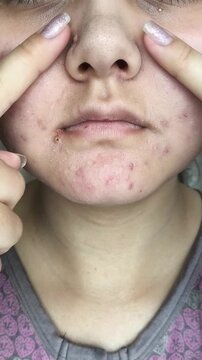 Close up of woman indicating acne-prone area on face, facial skincare, dermatology and healthy skin concept. problematic skin, skincare routine and dermatology awareness concept.