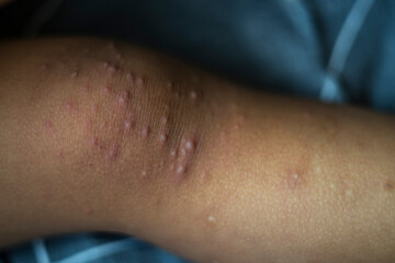 Fototapeta premium Red Rash On Toddler Foot From Hand Foot Mouth Disease