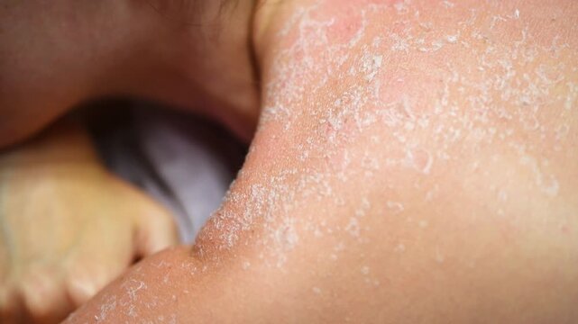 Close up sunburned skin peeling on shoulder and upper back under soft indoor lighting natural tones