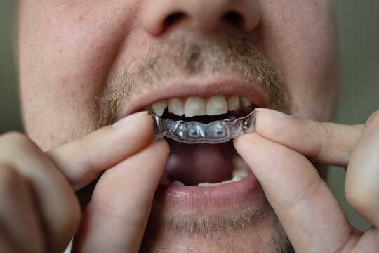 A man with a beige beard is shown inserting a clear aligner into his mouth in a neutral indoor setting. The close-up view highlights the hands and face, emphasizing the dental care process.