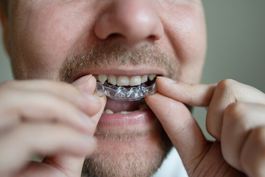 man carefully inserting clear aligner into his mouth using fingers, close-up shot in an indoor setting with a neutral background, emphasizing the precision and care involved in dental ortho.