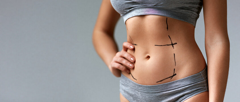 Abd&ocirc;men feminino com marca&ccedil;&otilde;es cir&uacute;rgicas para lipoaspira&ccedil;&atilde;o ou abdominoplastia. Conceito de cirurgia pl&aacute;stica e contorno corporal com espa&ccedil;o para texto