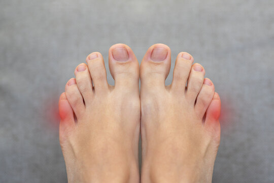 Inflammation on female foot with red spot. Concept of feet pain and disease