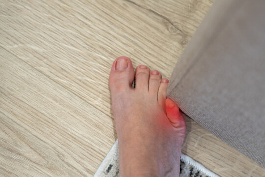 Woman hit furniture with the little toe. Incident at home. Red spot showing injury of foot little finger