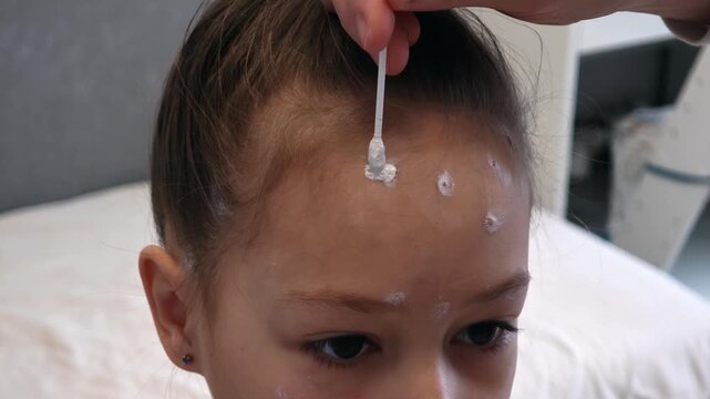 Mother applies chickenpox remedy on forehead of her daughter. Chickenpox treatment at home. 7 years old child with chickenpox. Mom lubricates rash from chickenpox with antiseptic using cotton bud.