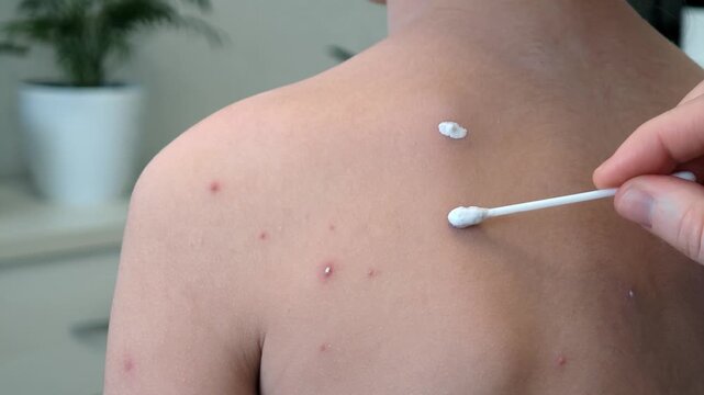 Mother applies chickenpox remedy on back of her child. Chickenpox treatment at home. 7 years old child with chickenpox. Mom lubricates rash from chickenpox with antiseptic using cotton bud.