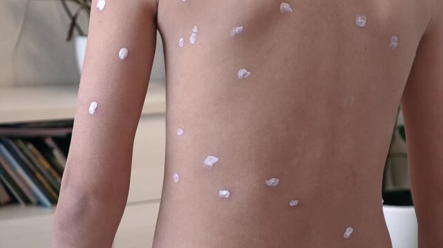 Back of child with chickenpox rash. Chickenpox treatment at home. 7 years old child with rash from chickenpox and with antiseptic on skin. Child suffers from chickenpox.