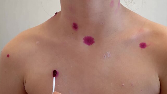 Mother applies chickenpox remedy on body of her child. Chickenpox treatment at home. 7 years old child with chickenpox. Mom lubricates rash from chickenpox with antiseptic using cotton bud.