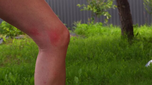 Woman scratches her leg after a mosquito bite, feels swelling and allergies.Insects bite woman legs at the green grass.