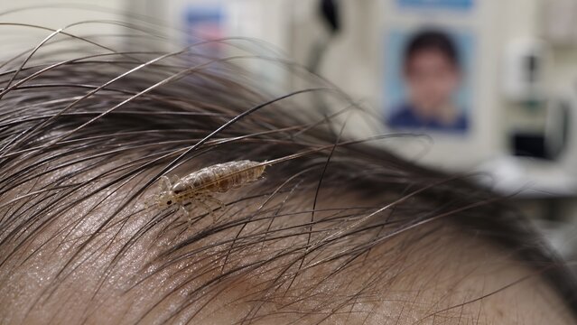 Microscopic photography of a single head louse moving along a human scalp, providing essential educational imagery for lice treatment, skin parasite awareness, and public health resources