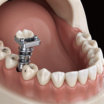 Tribal Tattoo Bridge 3D. A 3D Render Of A Jaw With Dental Implants And Supported Bridge