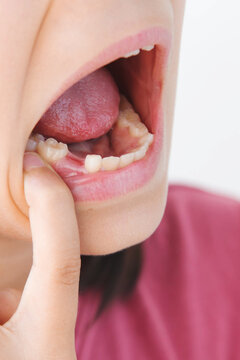 Child pointin at missing baby tooth inside open mouth showing natural tooth loss during childhood highlighting dental health, oral care, growing up, pediatric dentistry, healthy development 