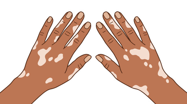 Close up of two hands with vitiligo skin condition showing patches of depigmentation on brown skin
