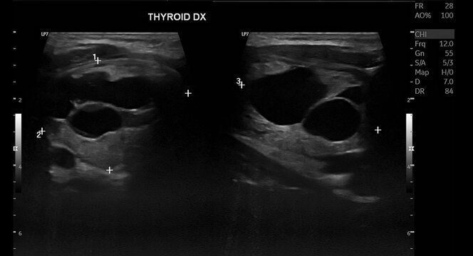 Thyroid Ultrasound Demonstrating Right Thyroid Nodule Classified as TI-RADS 3