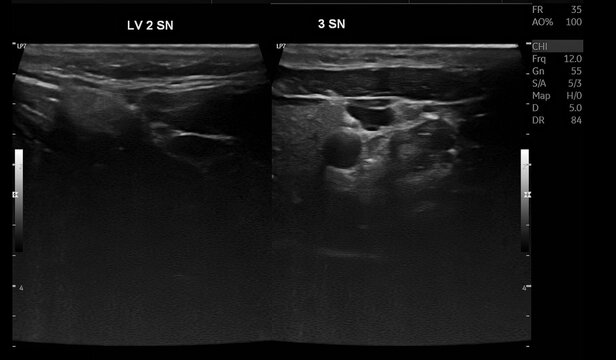 Thyroid Ultrasound Demonstrating Right Thyroid Nodule Classified as TI-RADS 3